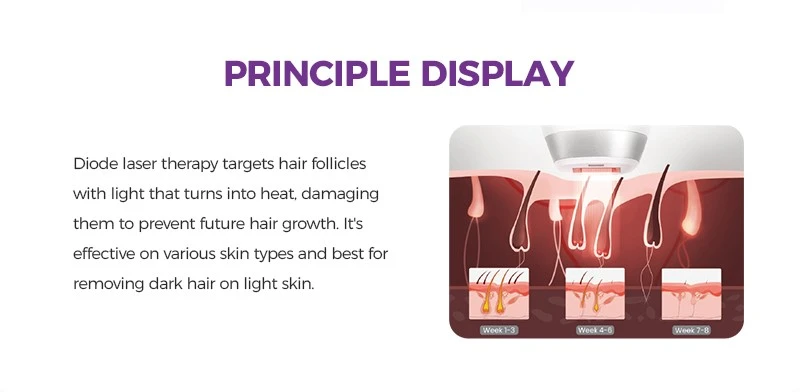 808nm Diode Laser Hair Removal Machine 808nm Diode Laser Hair Removal Machine